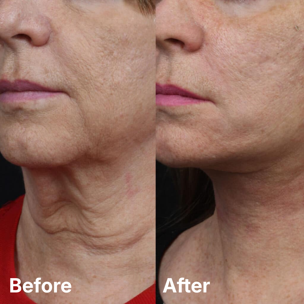 Age-Betraying Neck Recovery