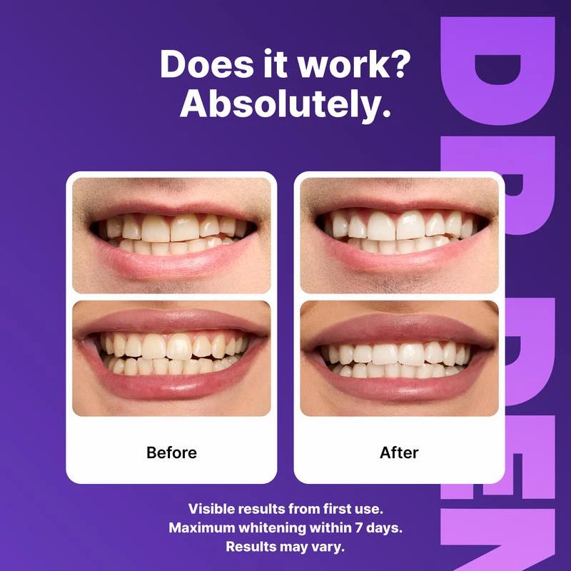 Purple Teeth Whitening Strips - 7/21 Whitening Sessions